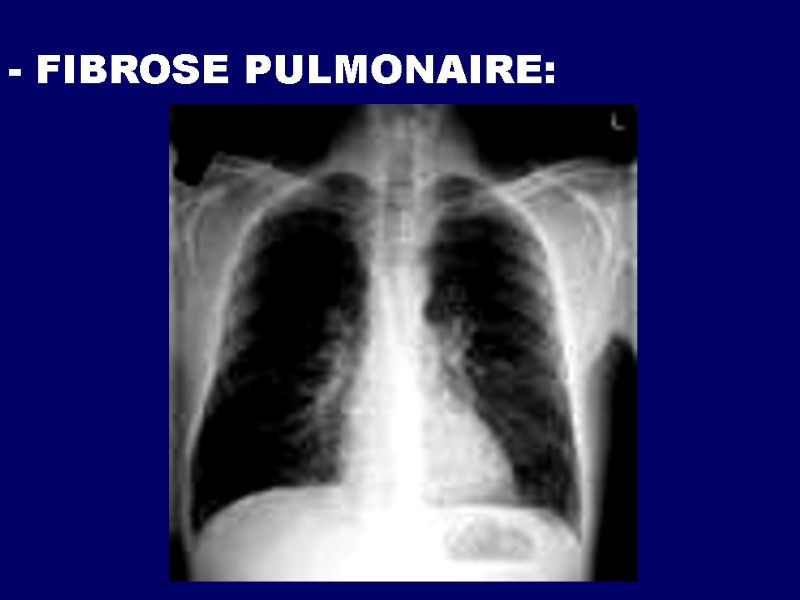 - FIBROSE PULMONAIRE: